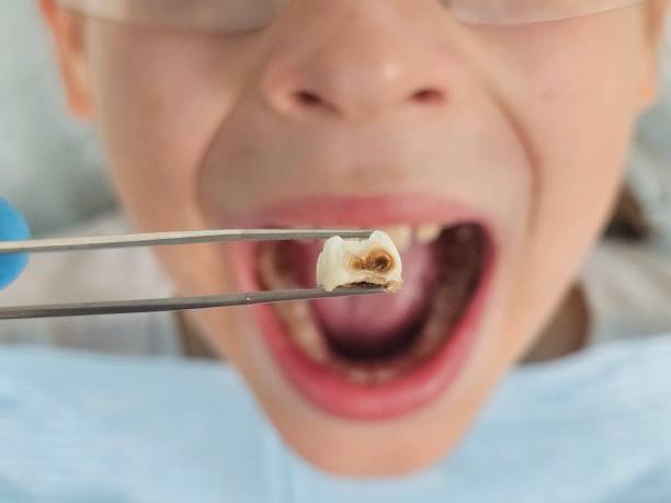 Best Emergency Tooth Extraction in Salem, WV